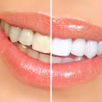 Whitening teeth – Teeth Bleaching