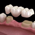 A dental bridge replaces missing teeth
