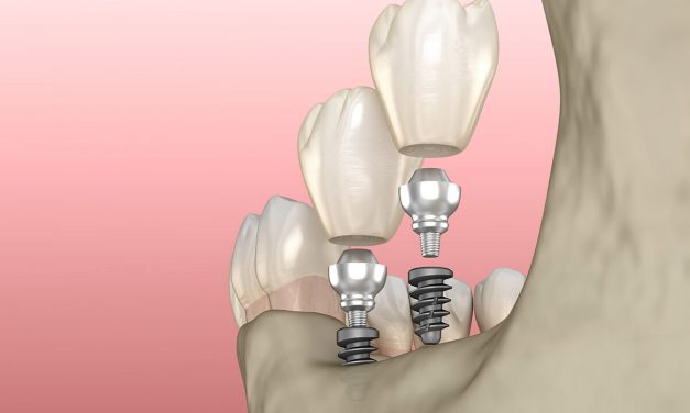 Dental implants – the way to a perfect smile and a firm bite