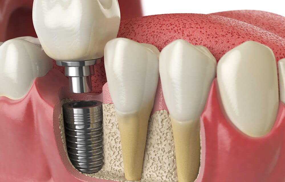 Dental Bridge, prosthesis or implant – THE BEST OPTION FOR YOU