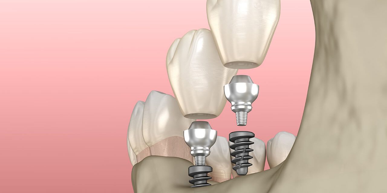 How to clean your dental implants like a pro