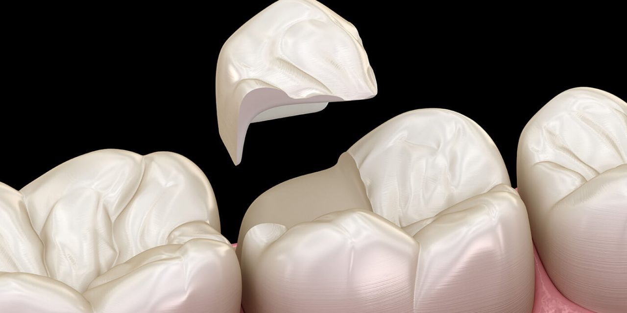 Cavity in a tooth? Inlay or onlay? Which one will help?