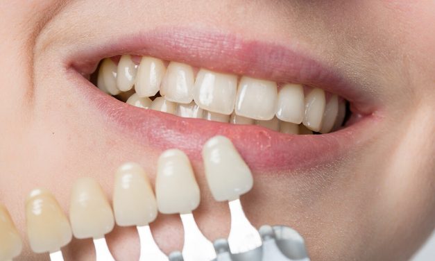 Laughing teeth show: Veneers make even cloudy teeth shiny again!